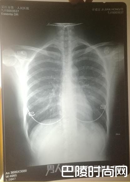 >苏州男子胸片被弄错为女性 一年后确诊肺癌晚期