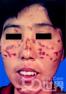 什么是面部脂溢性皮炎？