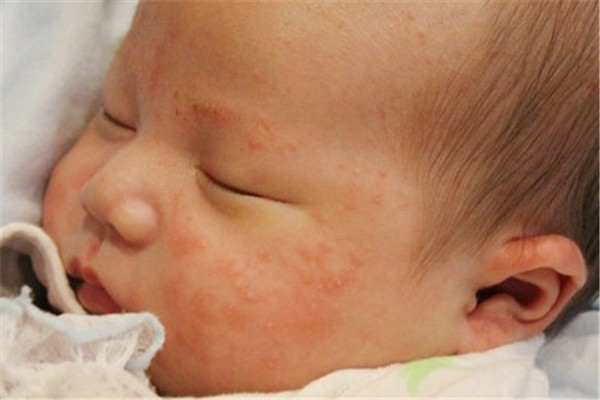 婴儿脂漏性皮肤炎怎么治