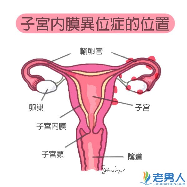 女性为什么会得子宫内膜异位症 症状病因详情介绍