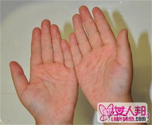 手部湿疹食疗方揭秘 几类常见湿疹的饮食方法
