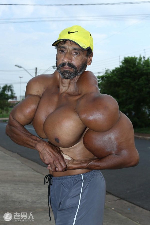 >巴西男子为健身注射燃油 60cm粗手臂变成“绿巨人”