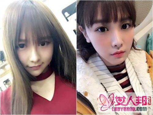 SNH48成员唐安琪脸部植皮手术已完成 事件真相是什么?(图)