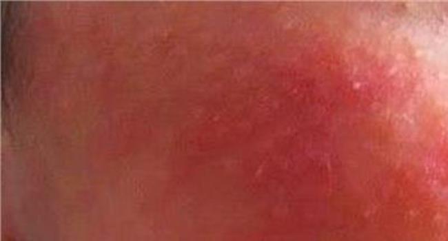 皮肤湿疹的治疗方法是什么