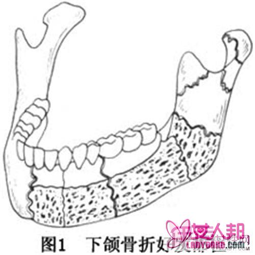 >下颌骨骨折好发部位有哪些 引发该部位骨折的外力特点介绍