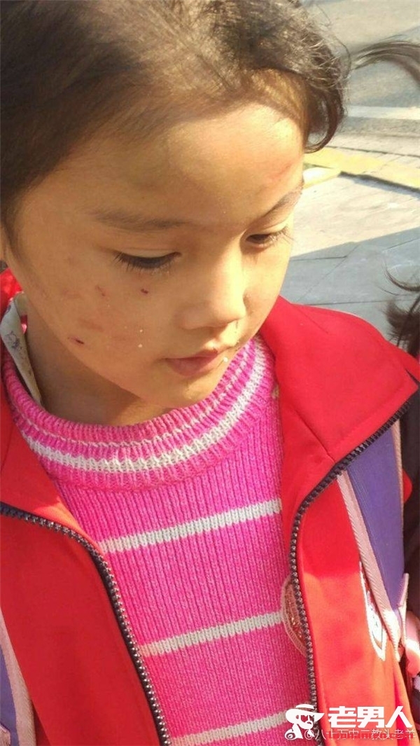 >长沙6岁女童疑遭虐待浑身上下都是伤 其母被刑事拘留