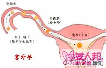 宫外孕手术过程图片详解 八大步骤让你了解过程