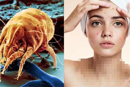 >怎么鉴别螨虫真菌引起的皮肤病 怎么治疗见效快
