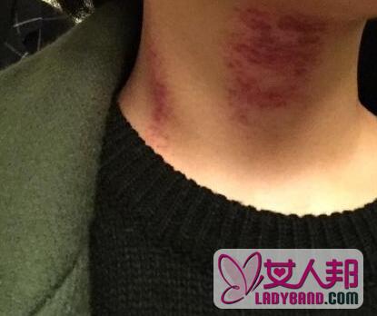 杨丞琳晒颈部刮痧照 网友：我感受过 真的痛
