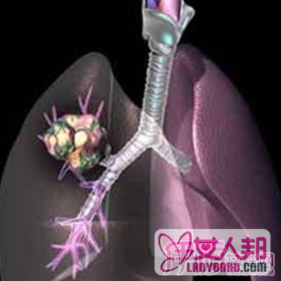肺癌晚期治疗方法   早治疗以绝后患