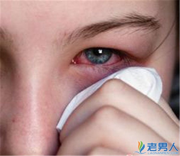 >红眼病有哪些表现及如何诊断 早期症状有哪些