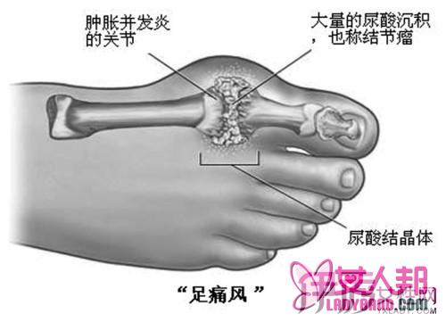 >脚痛风的症状大全 教你五个治疗原则轻松解决问题