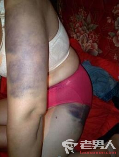 女子惨遭家暴20年 皮肤均成黑紫色
