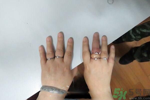 女子被5枚戒指咬手是什么原因？买戒指怎么确定自己的尺寸？