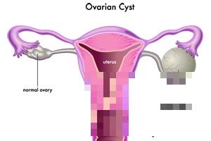 【卵巢肿大的症状有哪些】卵巢肿大的原因_卵巢肿大怎么治疗