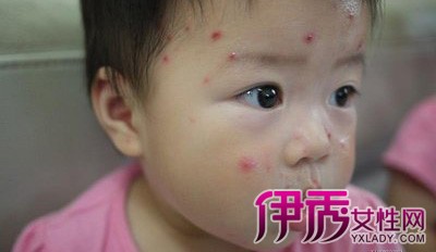 >小孩儿的水痘是怎么引起的 主要原因是不注意个人卫生导致的