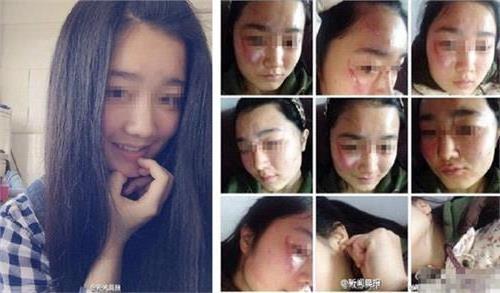 湖北女教师殴打女学生至其毁容 怀疑女生往其身上泼水(图)