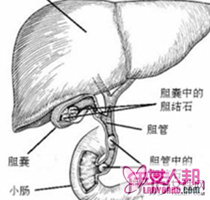 >小编为你收集肾结石排出示意图  带你深入认识和探索