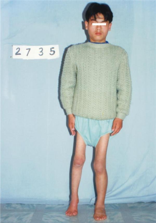 >杨鼎杨德清 58岁的小儿麻痹症患者杨德清:我终于有鞋穿了!