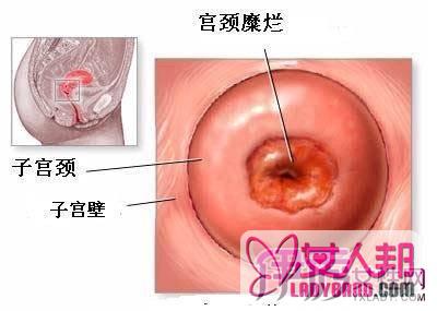 如何选择治疗宫颈糜烂的药 专家建议先捡查后治疗