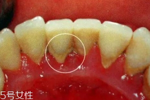 牙结石能自动脱落吗？除了洗牙别无他法