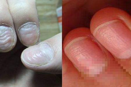 >手指甲凹凸不平怎么治 注意个人卫生是关键
