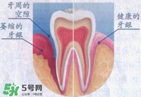 牙龈萎缩怎么办？牙龈萎缩症状