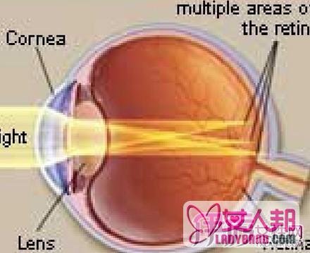 >散光度数多少算高  揭秘散光的临床表现