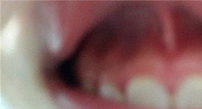 【标准牙槽骨图片】正常的牙槽骨全景片是什么样的