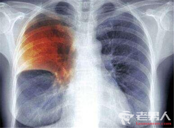 湖南一中学肺结核病事件 近90%的患病学生已经复学