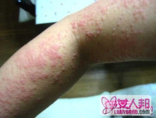湿疹治疗方法 如何预防湿疹？