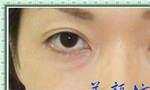 眼袋和黑眼圈的区别 黑眼圈和眼袋的区别是什么?