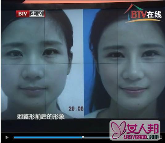 中国整容整形第一狂人 粉红宝宝整容失败前后照片曝光