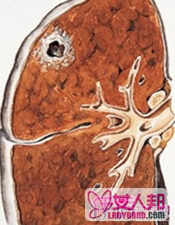 继发型肺结核的介绍 了解成人肺结核的最常见类型