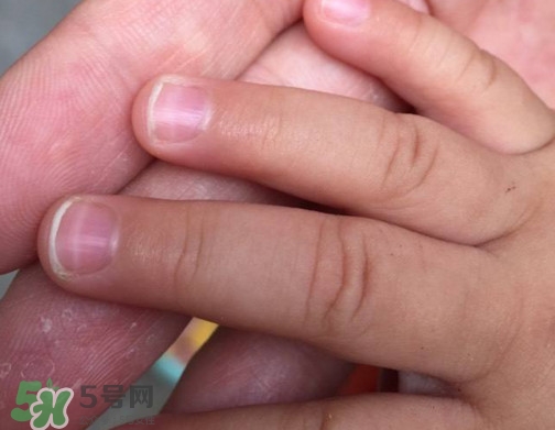 宝宝手指甲有白痕怎么回事？幼儿手指甲发白是缺钙吗