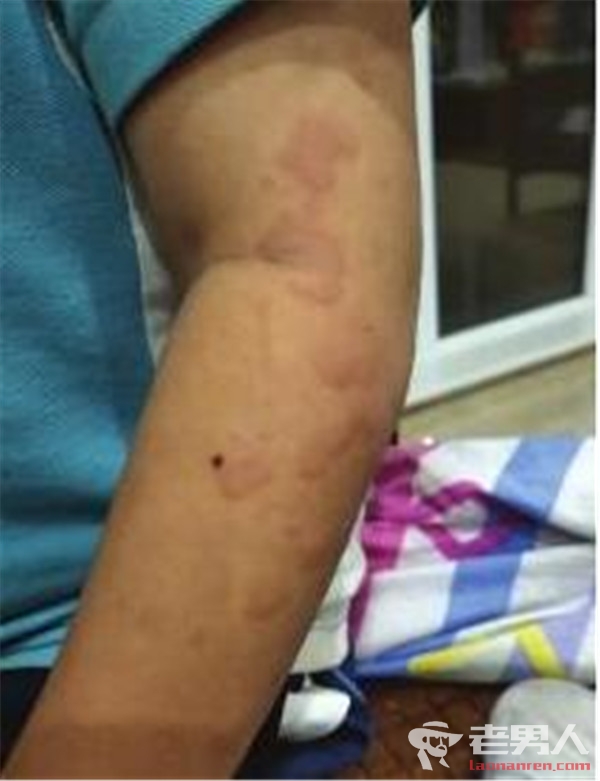8岁幼童校门口买仓鼠被咬伤 手上清晰看到一片红疹