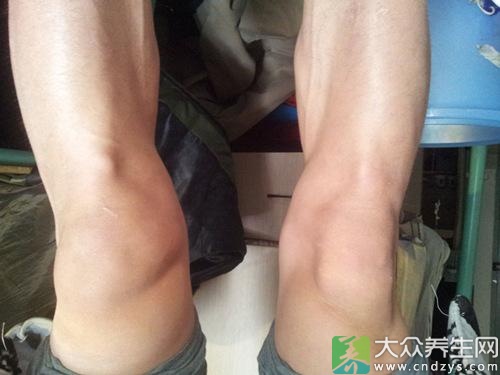 膝关节内侧疼痛的常见原因