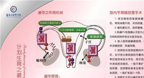 什么是埋线避孕 埋线避孕是怎么回事 上环和埋线哪个好