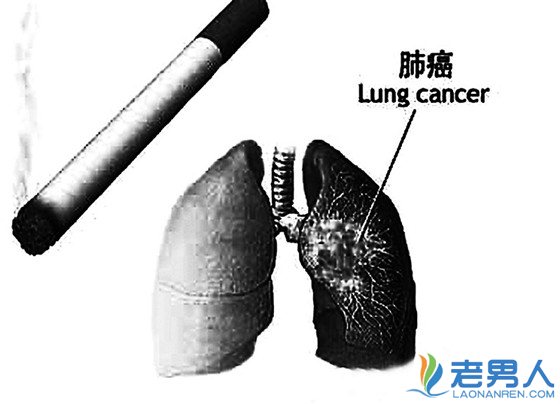 >肺癌的真正面目    台湾艺人徐风勇敢和它拼命