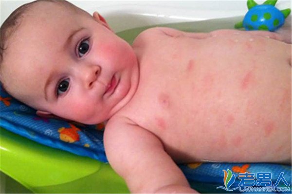 >宝宝湿疹是怎么引起的 最佳治疗方法你知道么