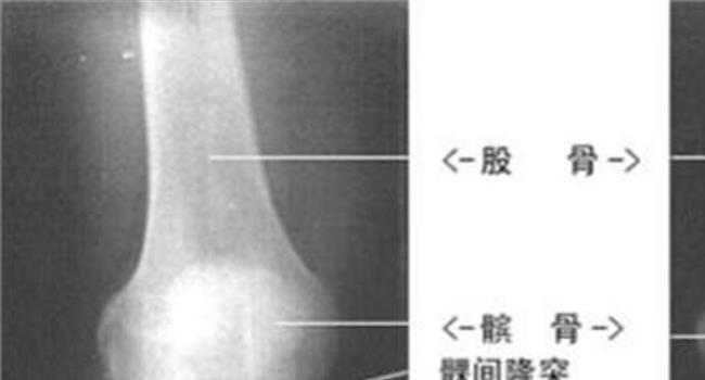 【膝盖各个部位疼痛图解】膝盖突然疼痛 小心骨坏死