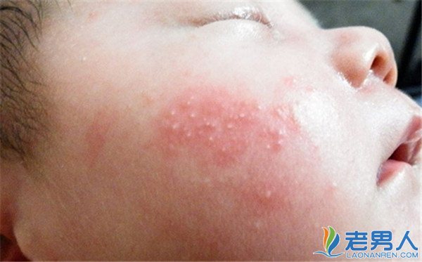 >幼儿急疹对宝宝有什么伤害 如何预防幼儿急疹