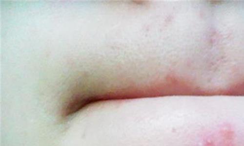 下巴两侧长痘痘 下巴两边经常长痘 是什么原因?