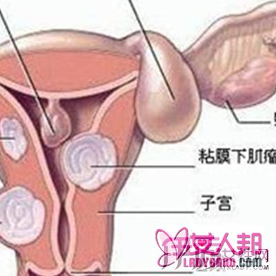 >子宫内膜炎b超能查出来吗 三个步骤可以查出子宫内膜炎