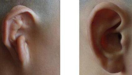 全扩张耳廓再造郭树忠 皮肤扩张法全耳再造的三步曲