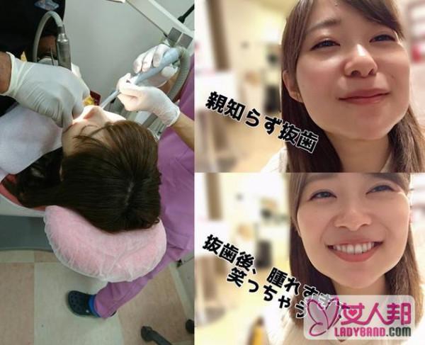>AKB48指原莉乃连拔四颗智齿 脸型变成了“肉包”形状