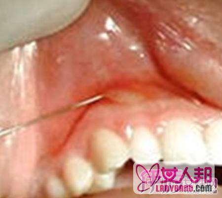 >牙槽脓肿怎么办 预防治疗是关键