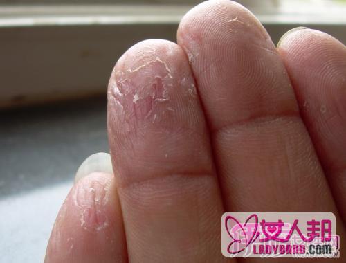>手指头脱皮是怎么回事  缺乏哪种维生素会导致脱皮