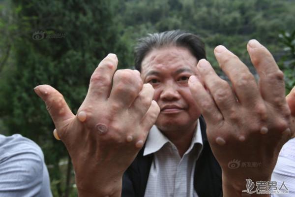 广西河池村民多人患怪病 手脚长“肿瘤”硬块（组图）