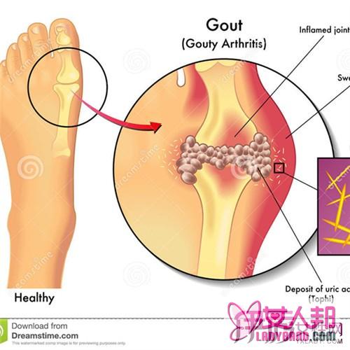 >痛风治疗小偏方 避免药物副作用